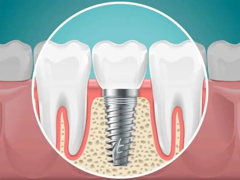 Illustration showing a dental implant supporting a replacement tooth
