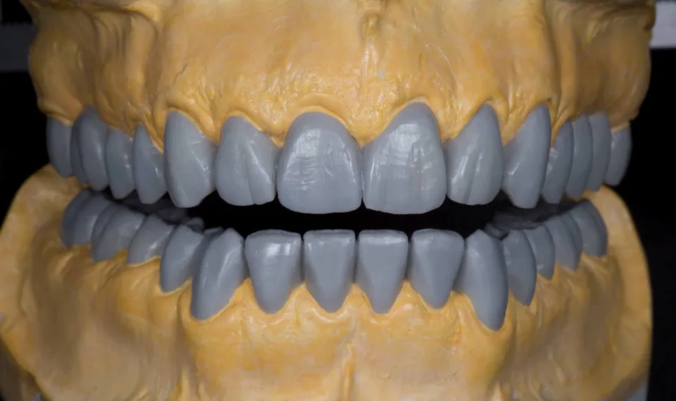 Example of a diagnostic wax-up on a dental model