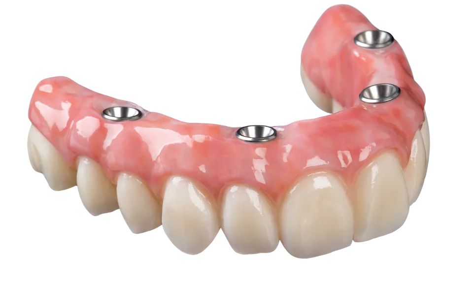 Illustration of a full-arch restoration supported by four implants
