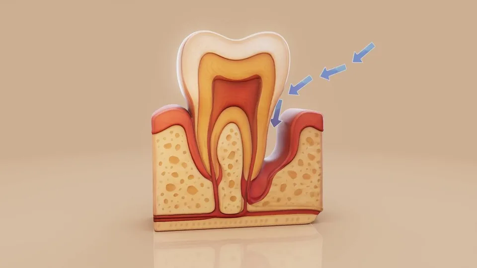 Conceptual illustration of a gum pocket beside a tooth